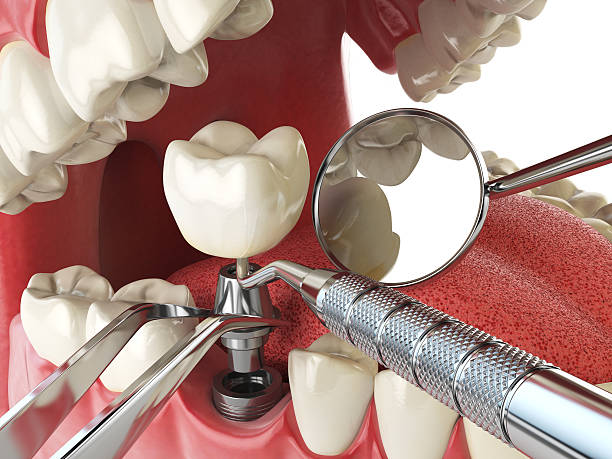 Best Emergency Wisdom Teeth Removal in Sharpsburg, NC